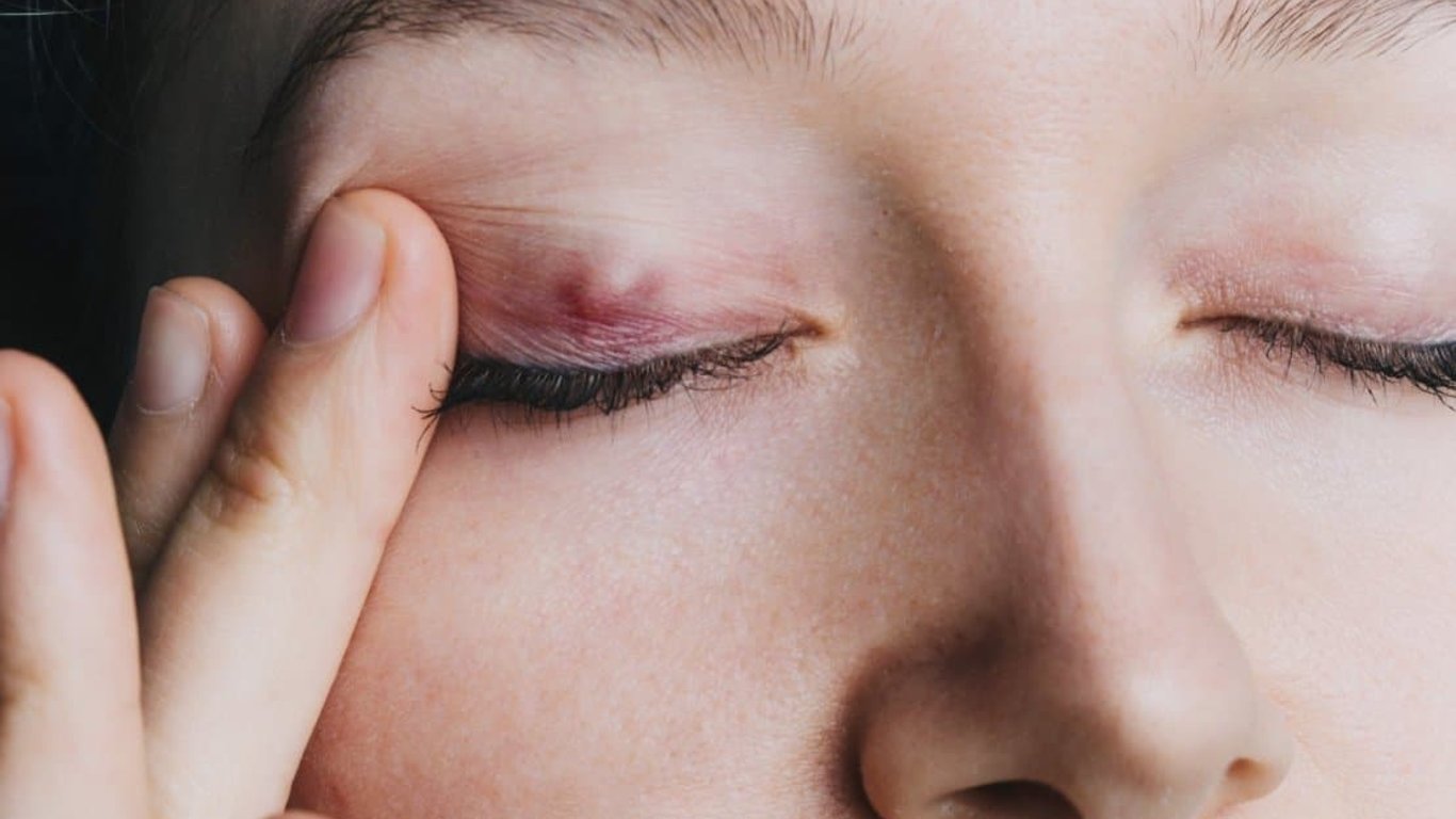 A Huge Helminth Was Removed from a Woman's Eyelid in Rivne Region
